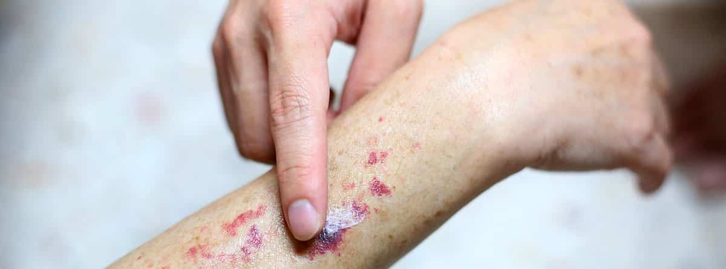 Petéquias com Laser Diodo
