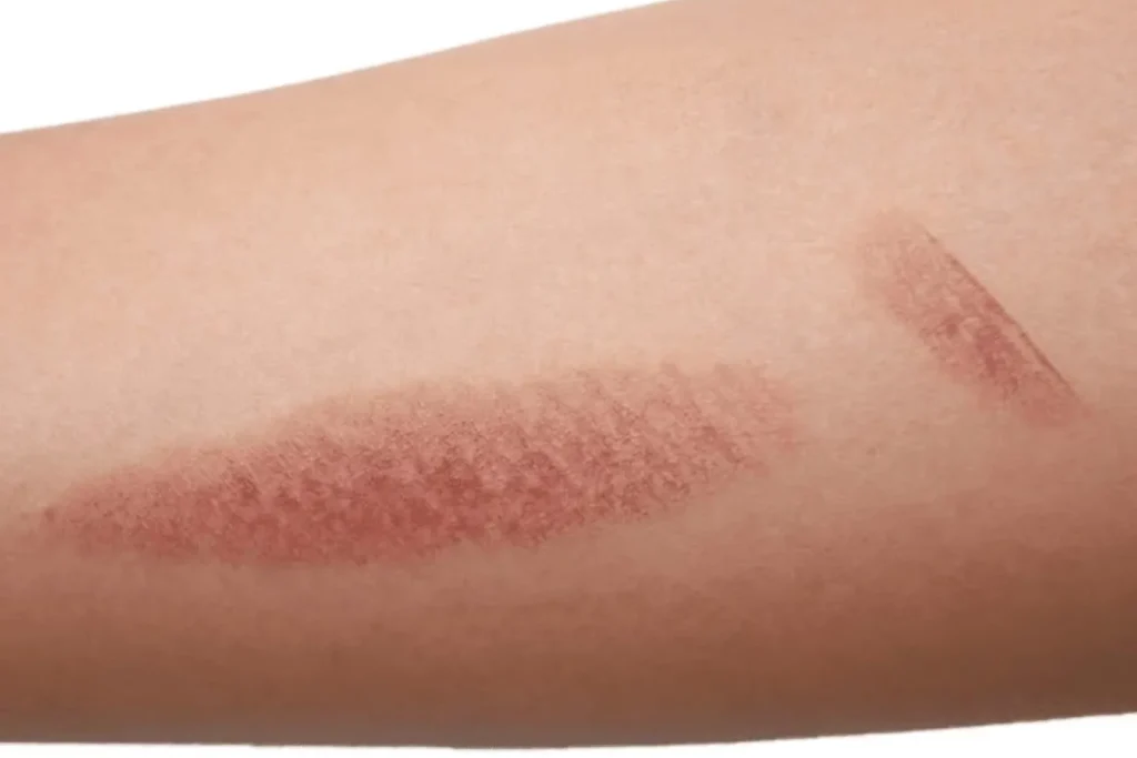 Queimadura na Depilação a Laser: Riscos e Prevenção